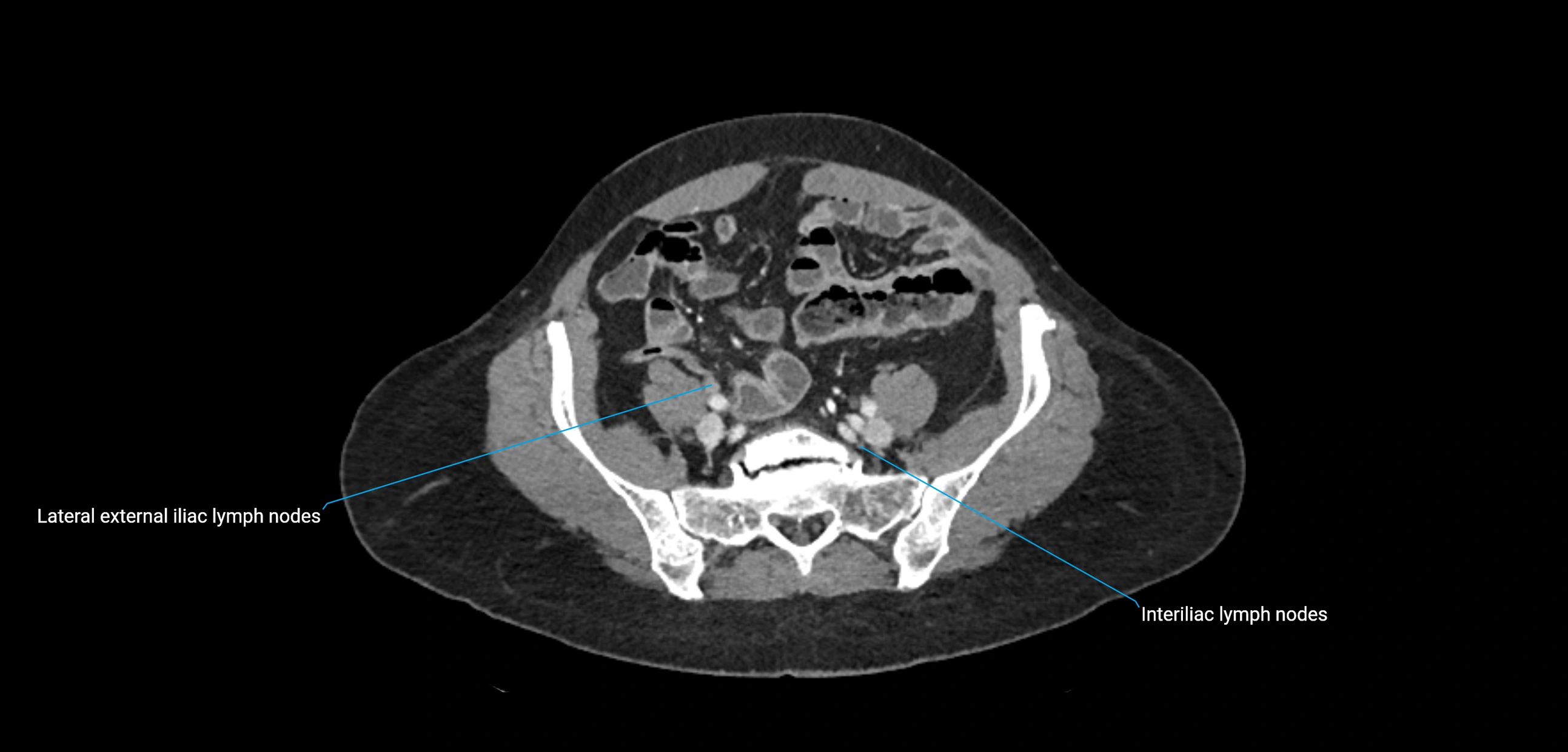 CT ct abdominal lymph nodes  axial cross sectional anatomy  enchanced radiology image -img-00002-00318.webp